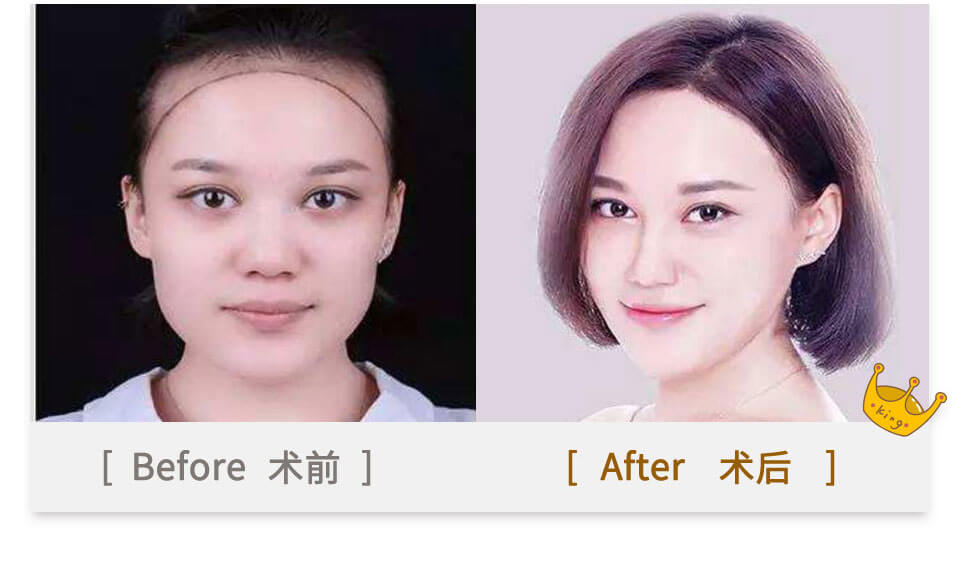 hair transplant in guangzhou china for girls